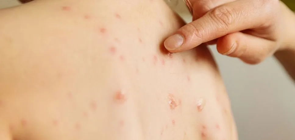 Autoritățile sanitare, în alertă. Au fost confirmate încă 6 cazuri de rujeolă