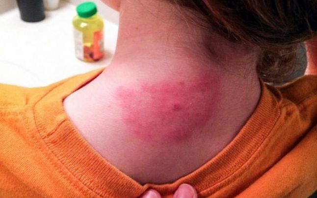 Cazuri confirmate de boala Lyme, la Buzău